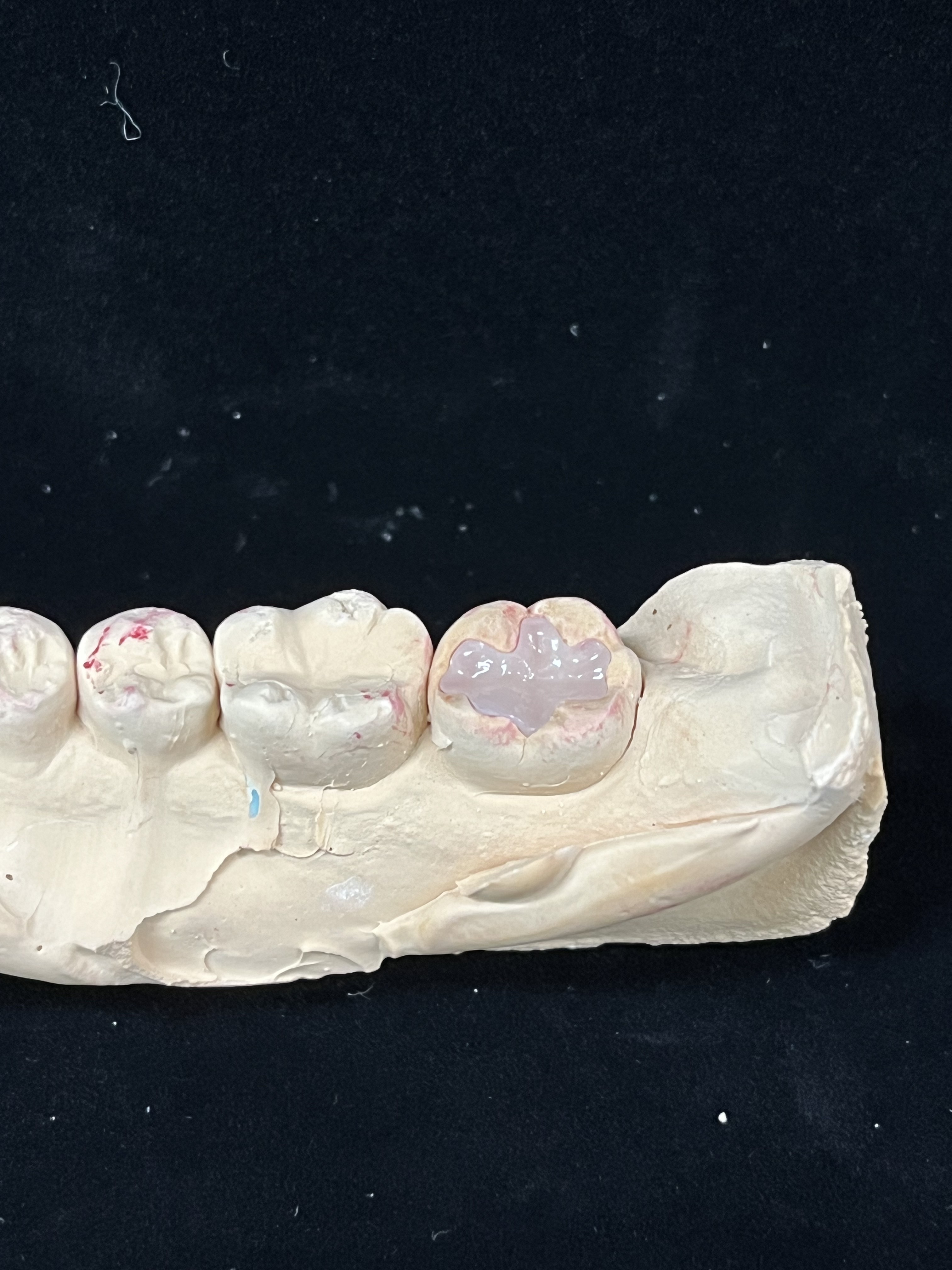 지르코니아 인레이 교합면